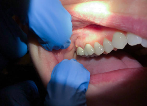 Best Emergency Gum Treatment in Chelsea Cove, NY